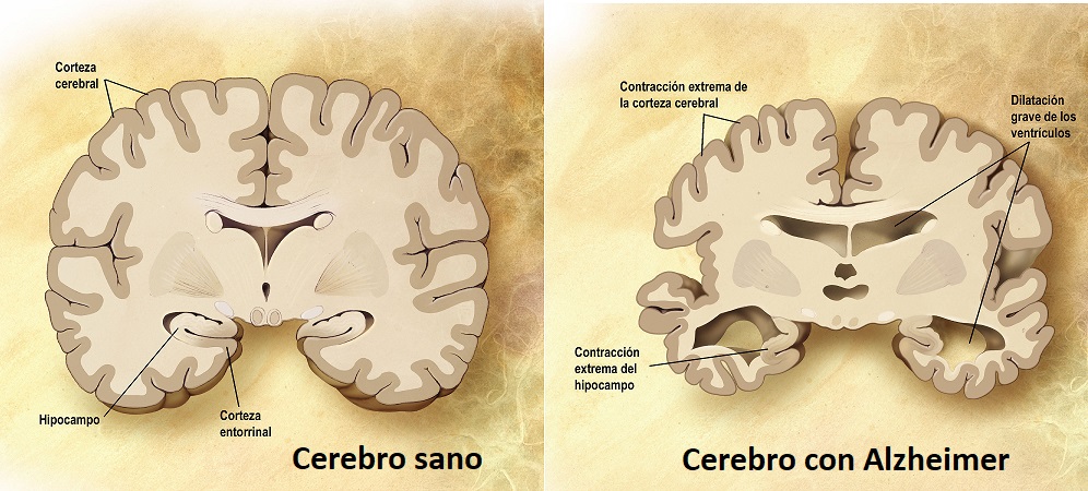 Cerebro-Alzheimer