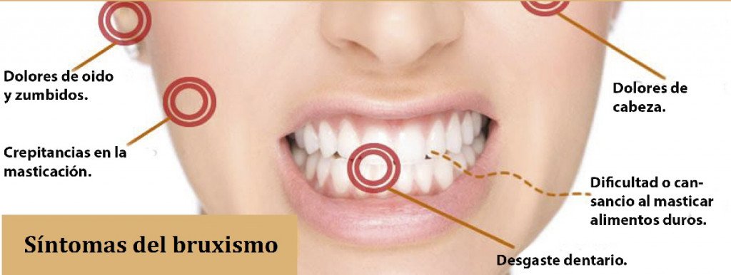 sintomas bruxismo