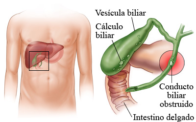 calculo biliar