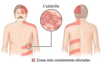 herpes-culebrilla