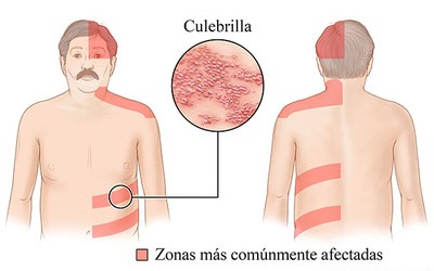 herpes-culebrilla