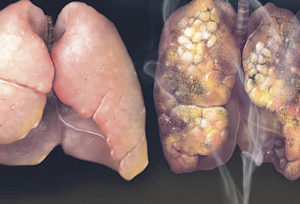 PULMONES