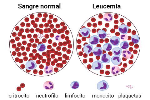 leucemia