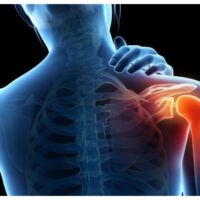 hombro-congelado-capsulitis