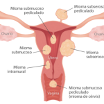 miomas