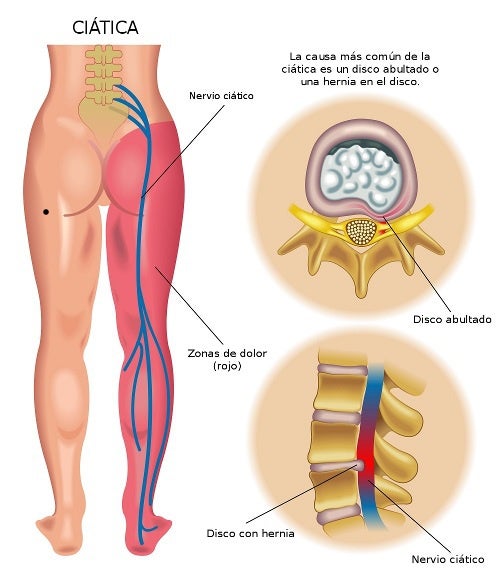 quitar dolor ciatica