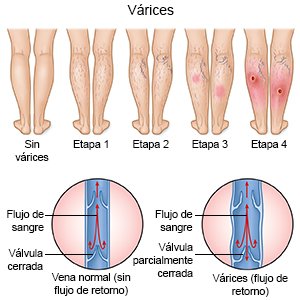 varices