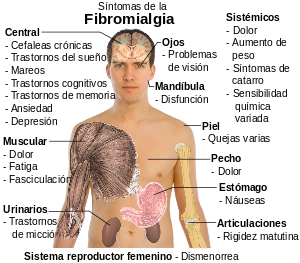 Sintomas_de_la_fibromialgia