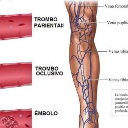 Trombosis