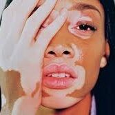 sanar-Vitiligo
