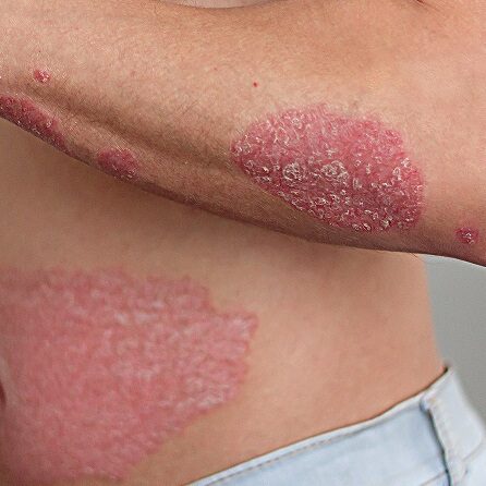 sanar-eczema-psoriasis