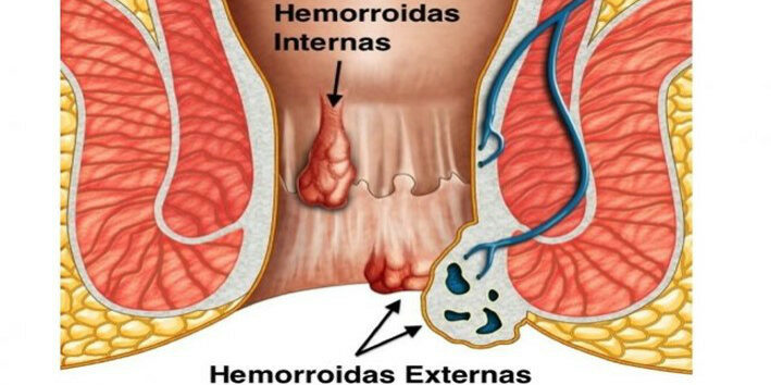 hemorroides1 hemorroides1