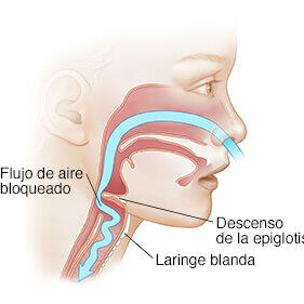 Lateral view of child's face showing blocked air flow caused by laryngomalacia.