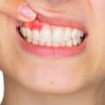 periodontitis