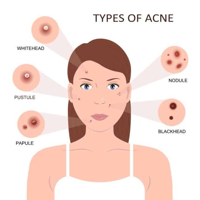 como sanar acne-espinillas-granos