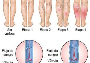 varices